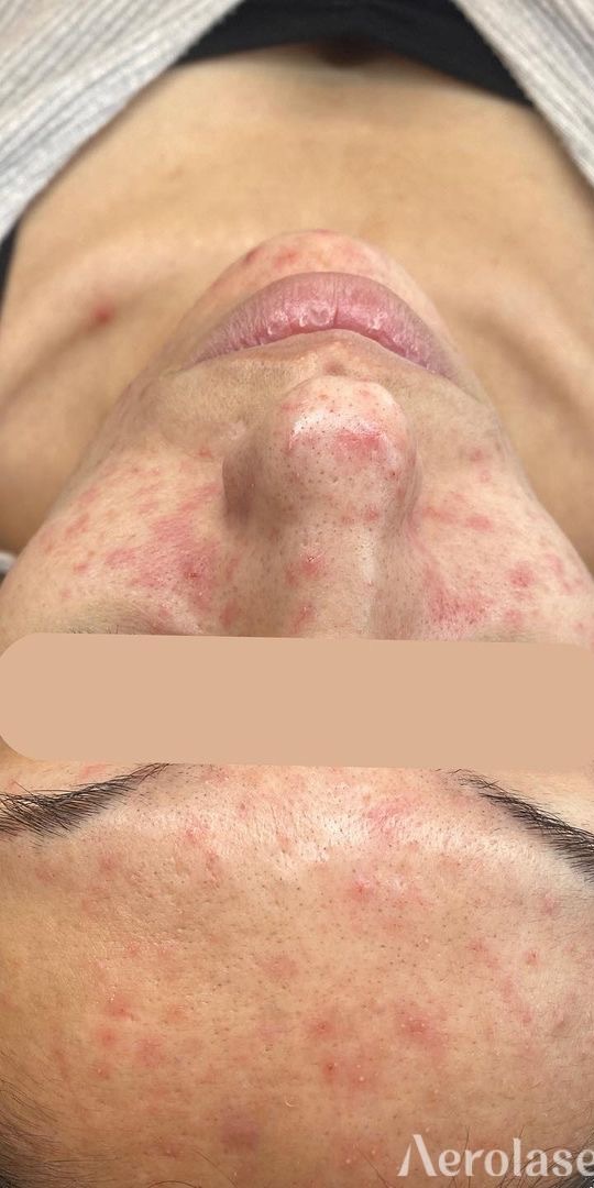 Acne — Before treatment