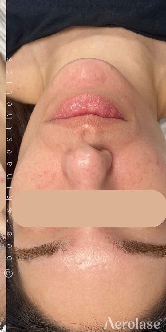 Acne — After treatment