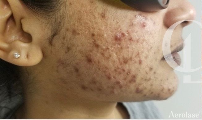 Acne — 3 Treatments — Before treatment