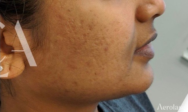 Acne — 3 Treatments — After treatment