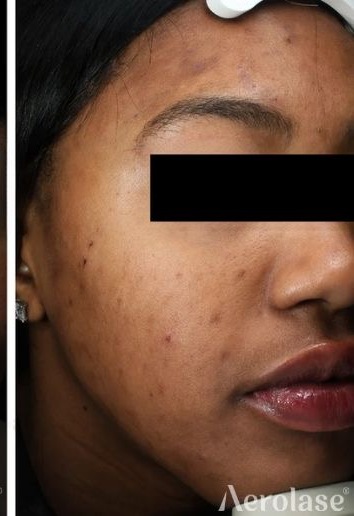 Acne & PIH — 5 Treatments — After treatment