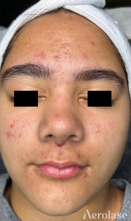 Acne — Before treatment 2