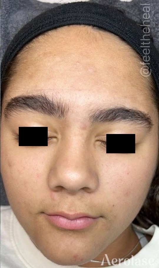 Acne — After treatment 2