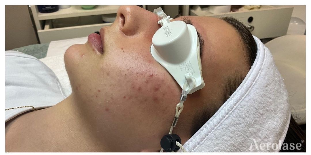 Acne — Before treatment 3