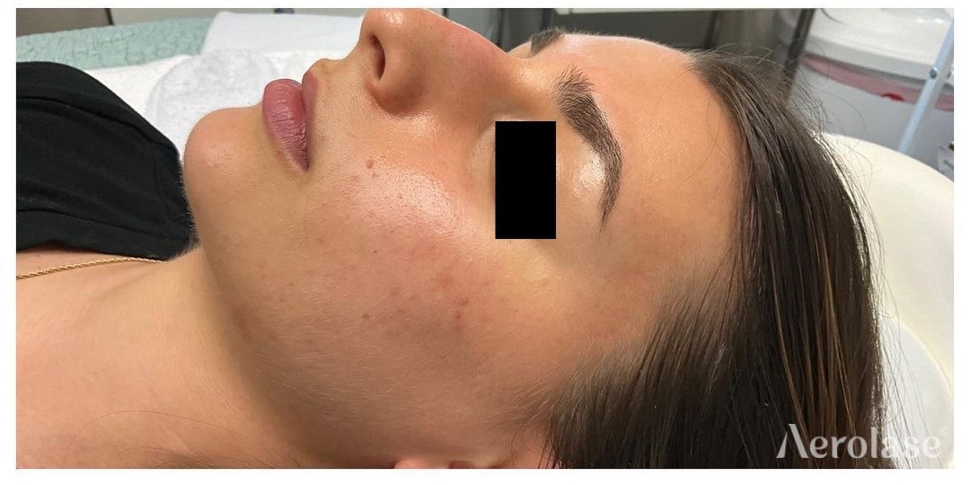 Acne — After treatment 3