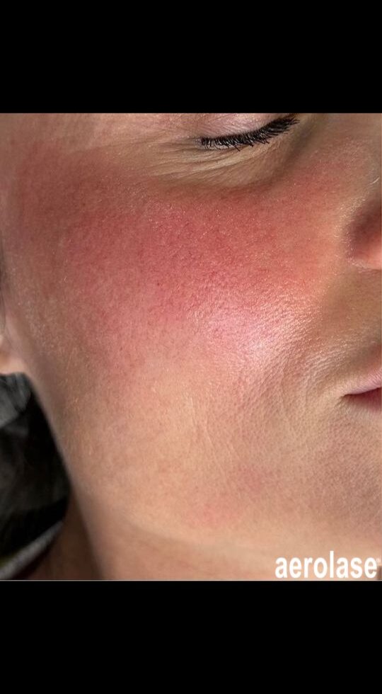Rosacea Reduction — Before treatment