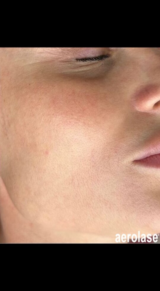Rosacea Reduction — After treatment