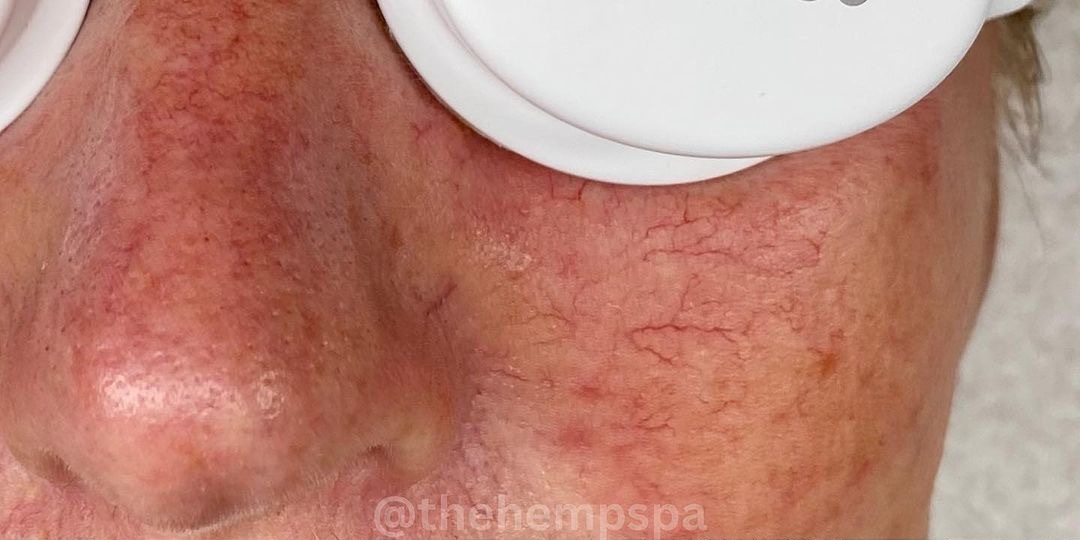Facial Veins & Redness — Before treatment