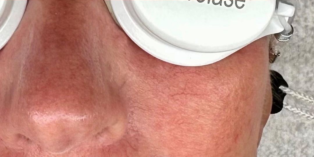 Facial Veins & Redness — After treatment
