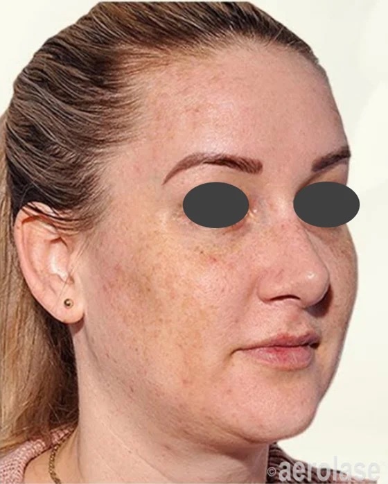 Melasma — 4 Treatments — Before treatment