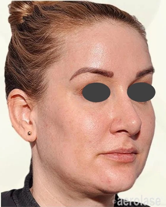 Melasma — 4 Treatments — After treatment