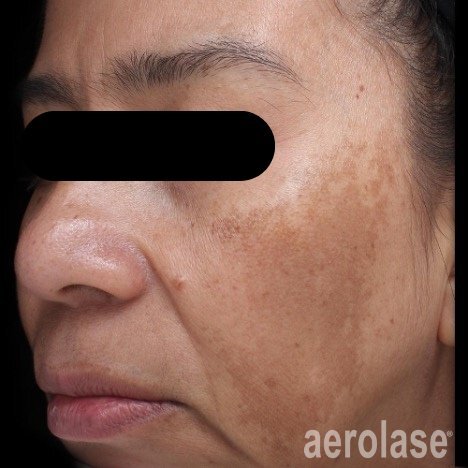 Melasma Correction — Before treatment