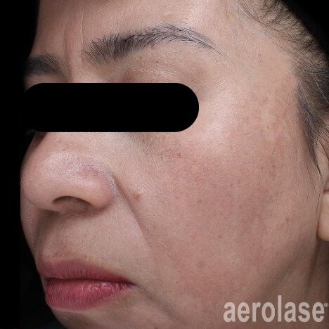 Melasma Correction — After treatment
