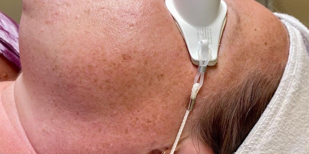 Pigmentation & Sun Damage — Before treatment