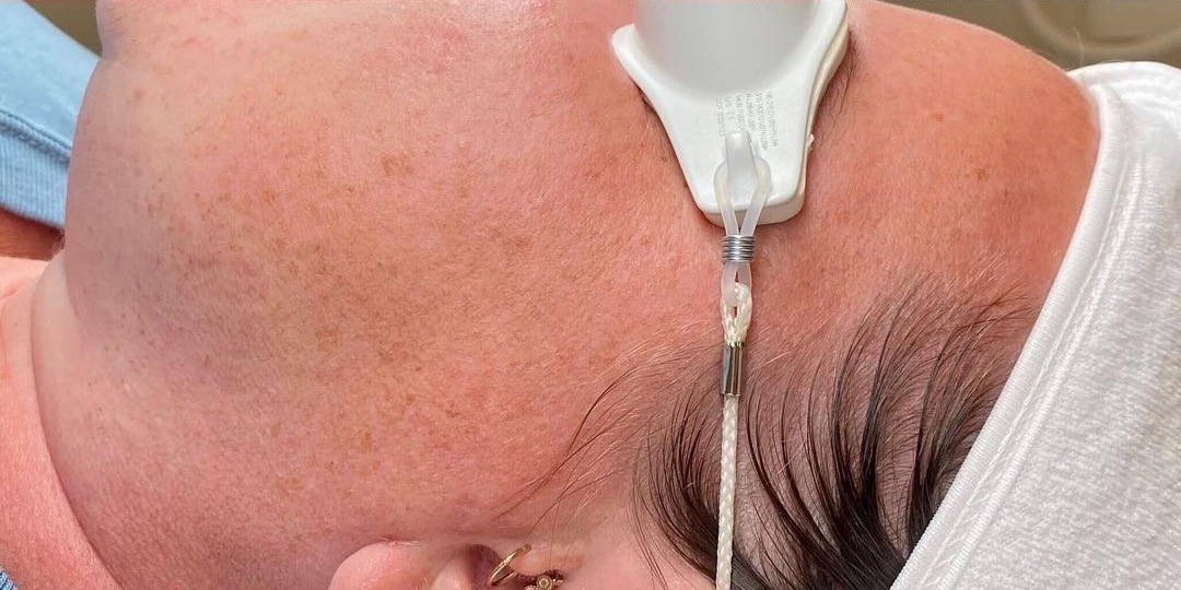 Pigmentation & Sun Damage — After treatment