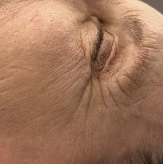 Pigmented Spots — Before treatment