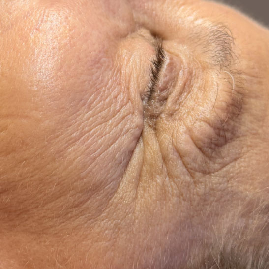 Pigmented Spots — After treatment