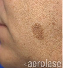 Sun Spot Removal — Before treatment