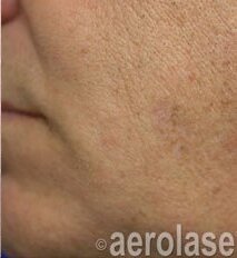 Sun Spot Removal — After treatment