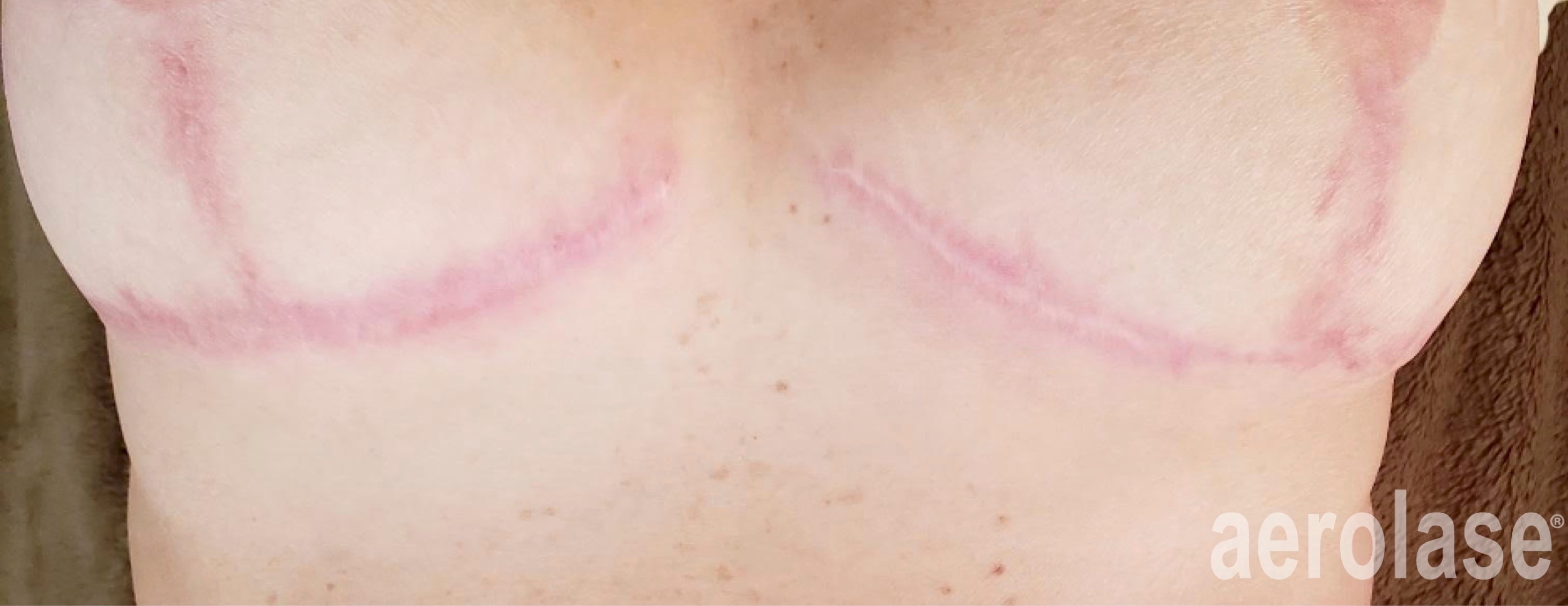 Post-Surgical Scars — Before treatment