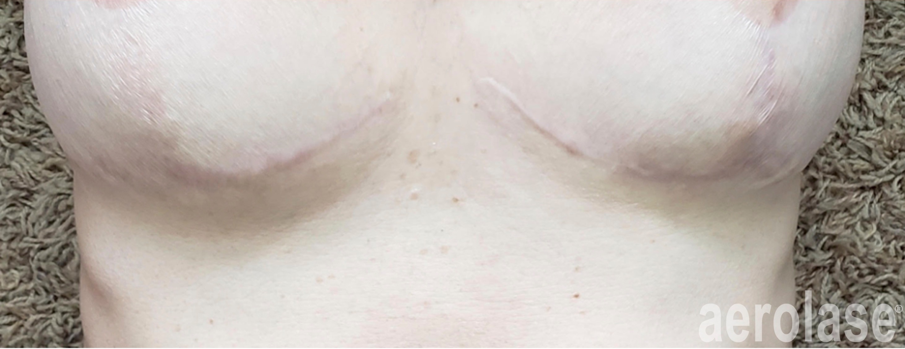 Post-Surgical Scars — After treatment