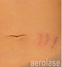 Scar Revision — Before treatment