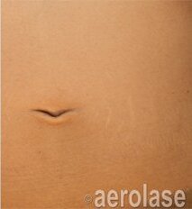 Scar Revision — After treatment