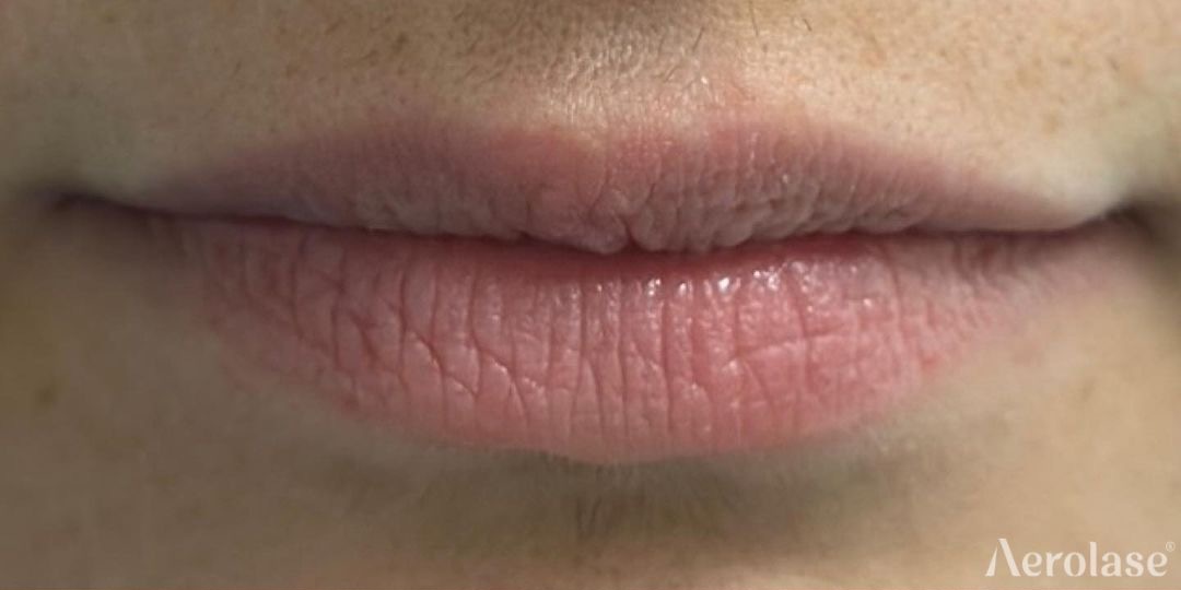 Lip Rejuvenation — 1 Treatment — Before treatment