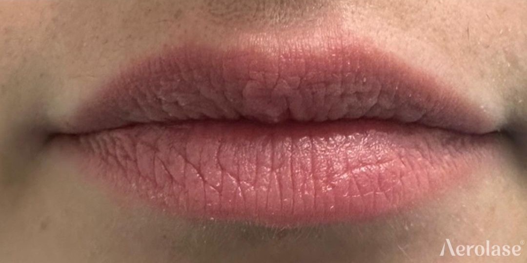 Lip Rejuvenation — 1 Treatment — After treatment
