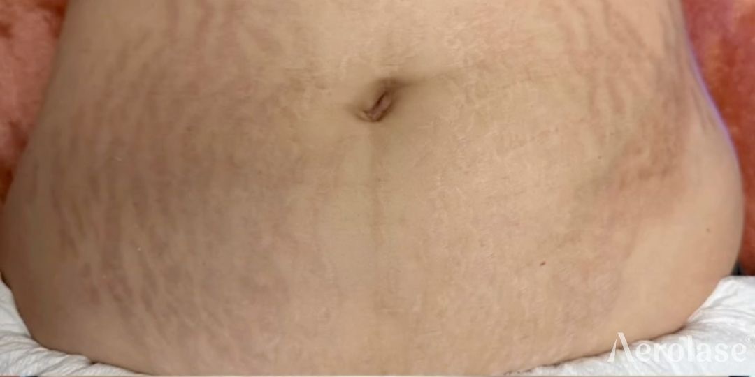 Stretch Marks — Stomach — Before treatment