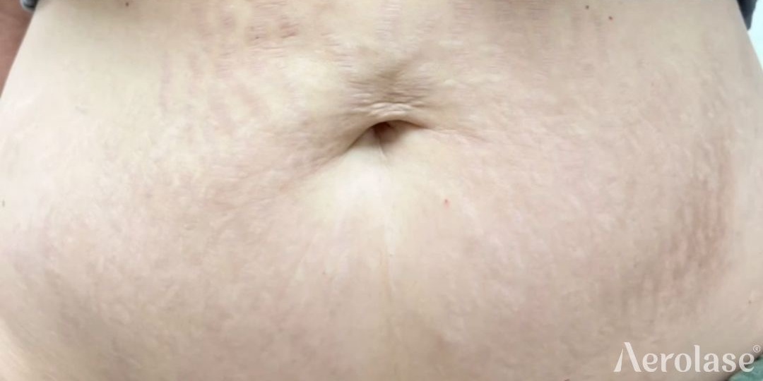 Stretch Marks — Stomach — After treatment