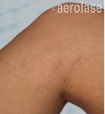 Spider Veins — Legs — Before treatment