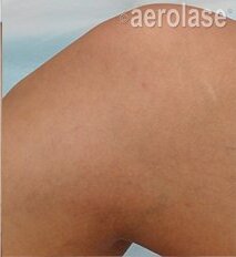 Spider Veins — Legs — After treatment