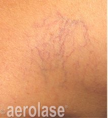 Spider Vein Reduction — Before treatment