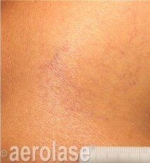 Spider Vein Reduction — After treatment