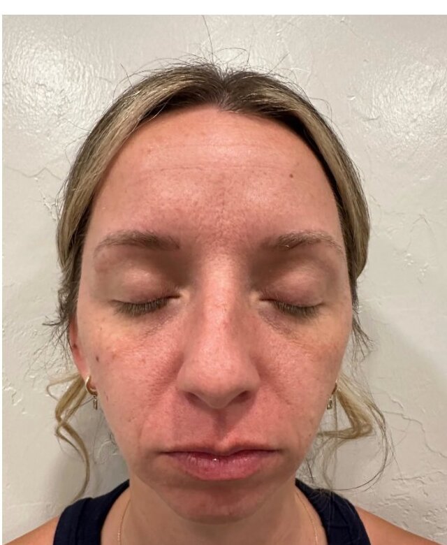 Microneedling — Before treatment
