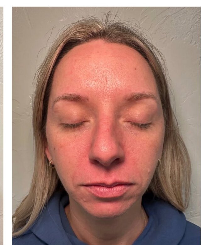 Microneedling — After treatment