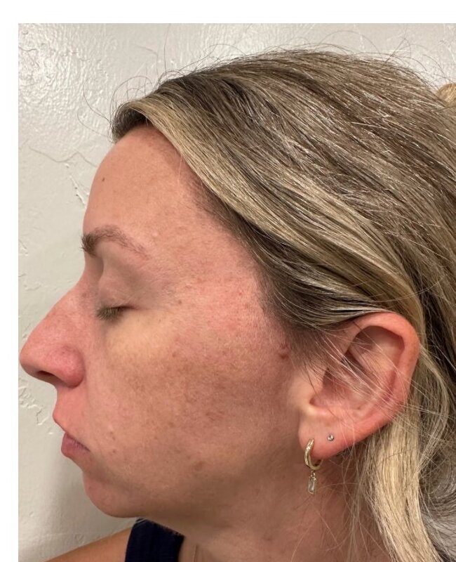 Microneedling — Before treatment 2
