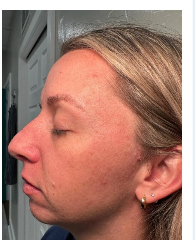 Microneedling — After treatment 2