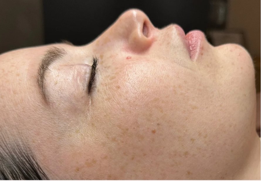 Dermaplane + ZO Stimulator Peel — Before treatment