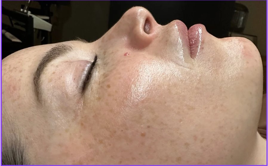 Dermaplane + ZO Stimulator Peel — After treatment