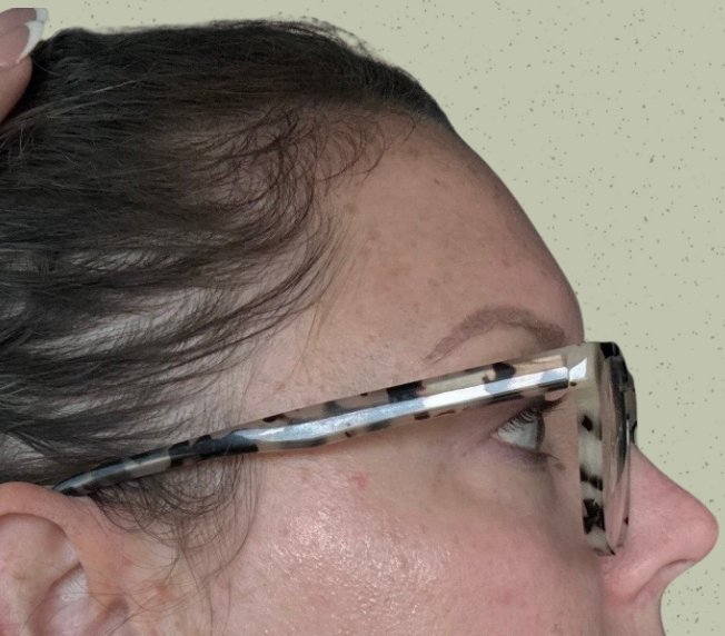 Hair Restoration — Before treatment