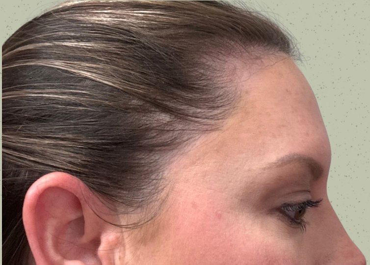 Hair Restoration — After treatment