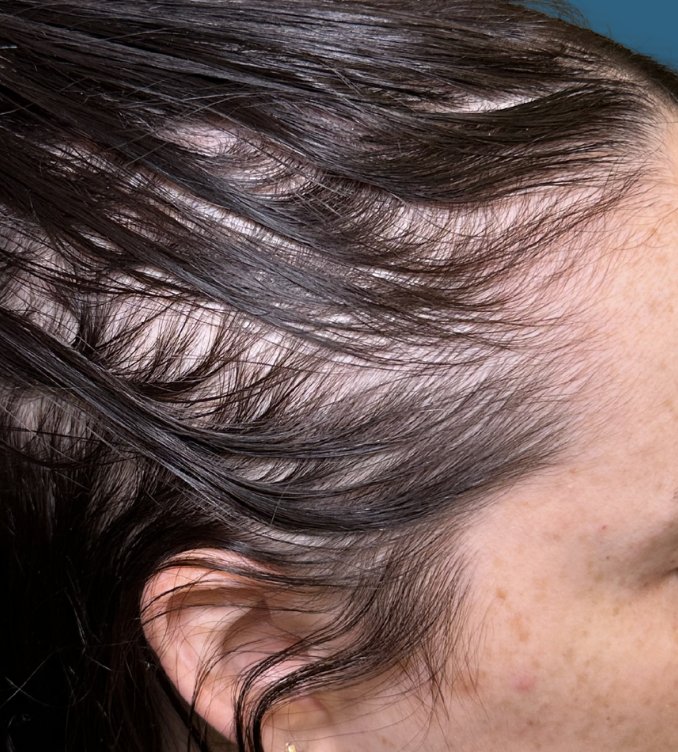 Hair Restoration — Before treatment 2