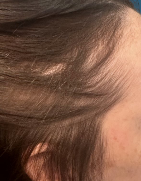 Hair Restoration — After treatment 2