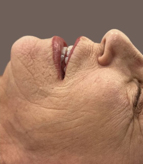 Fine Lines & Wrinkles — Before treatment