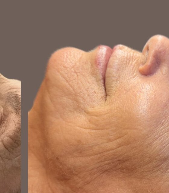 Fine Lines & Wrinkles — After treatment